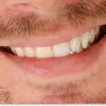whiten-teeth-before-after